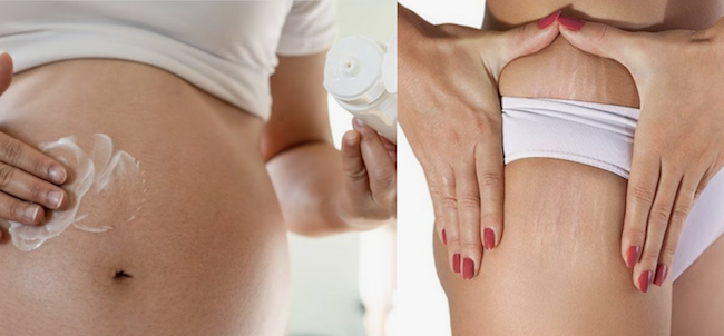 The Best Stretch Mark Scream for Your Options